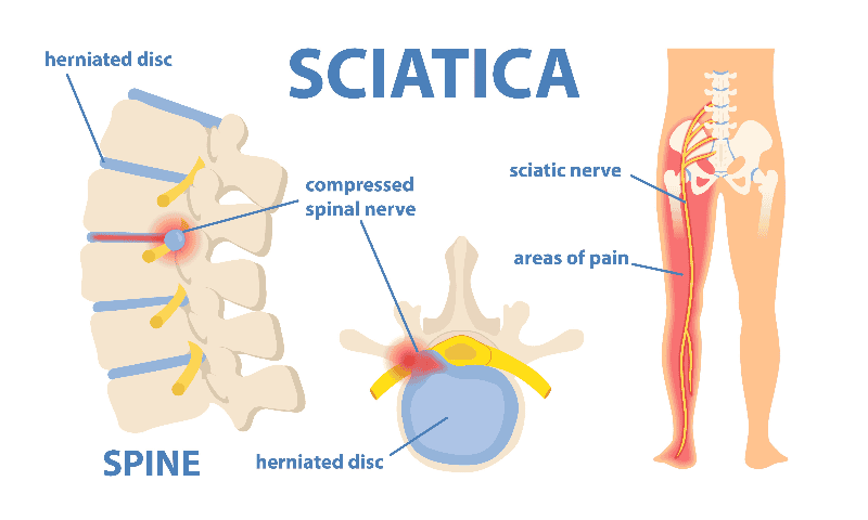 Diagram of a lumbar disc