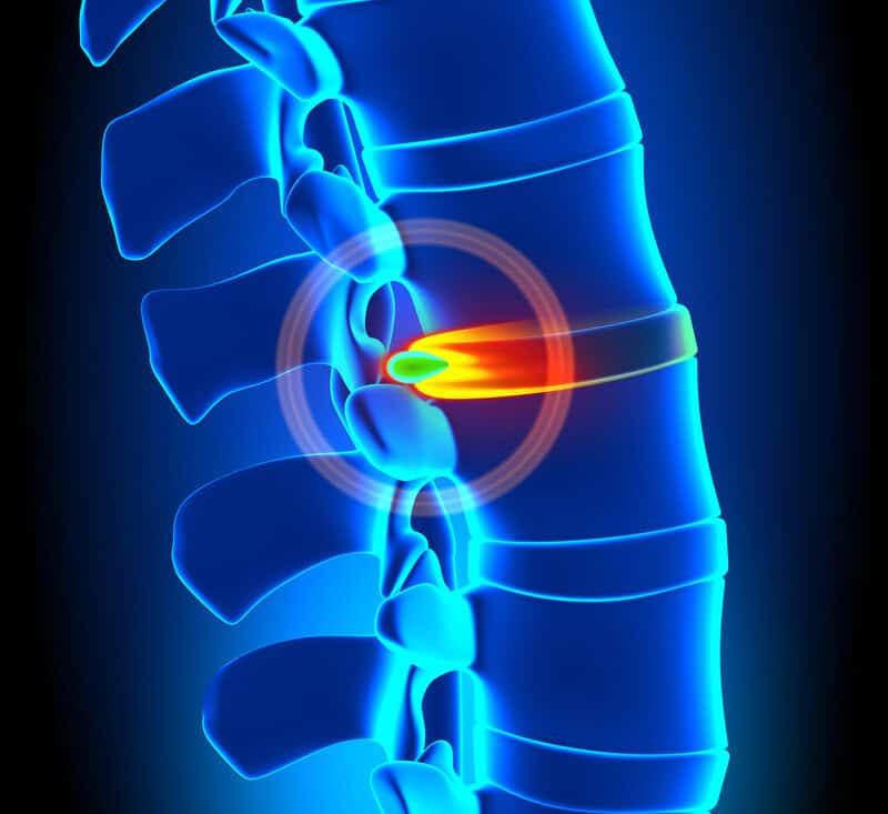 Herniated Disc Aggravating a Nerve