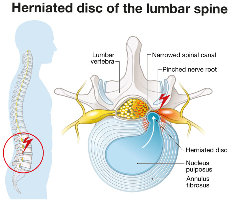 Illustration showing lumbar vertebra with intervertebral disc and herniated nucleus pulposu