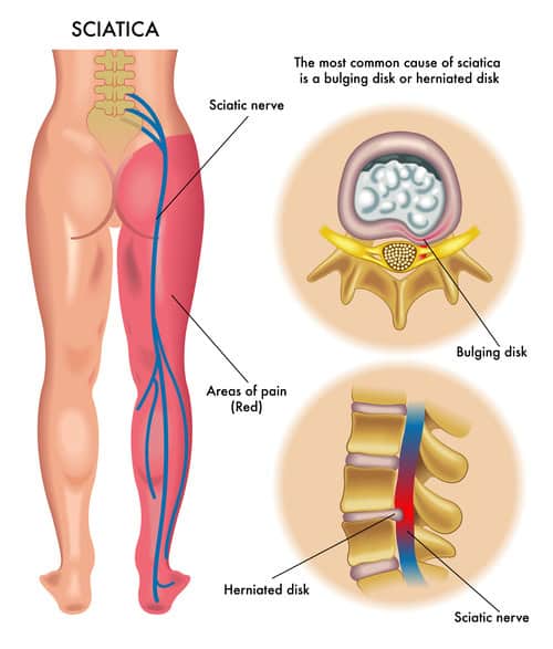 Diagram of sciatica