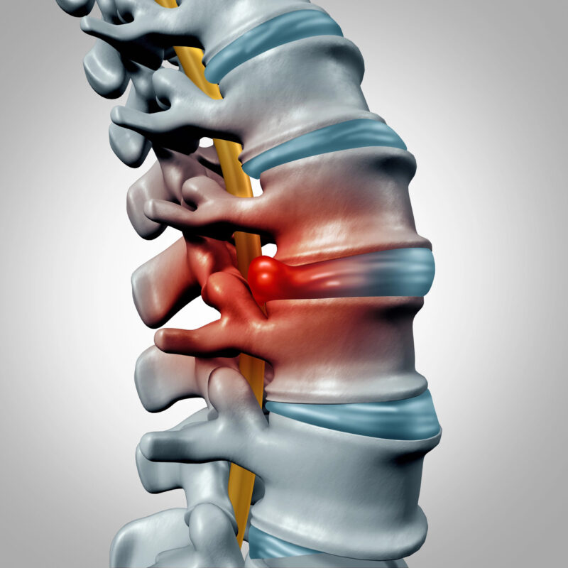 Spine degeneration